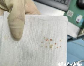 慢性胃炎？兩味藥，一清一溫，解決問題，請你體會