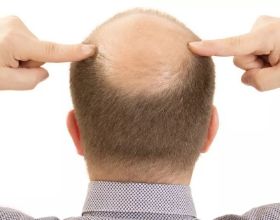 每天頭髮脫落不超過100根算正常，如何預防？