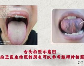 中醫治療脂溢性皮炎方法多，速看