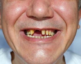老年人一般多少歲才開始“掉牙”？牙齒脫落後，需要注意什麼？