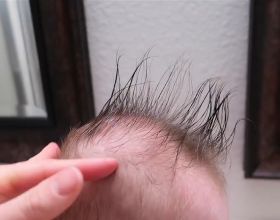 為啥新生兒有的頭髮，有的沒頭髮？沒頭髮的寶寶是發育晚嗎？