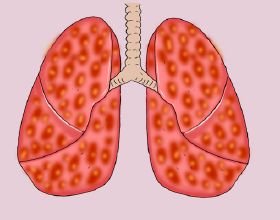 一個肺癌患者的自述：肺癌是如何折磨我的？我是如何成功抗癌的？