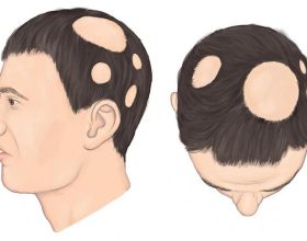鬼剃頭是怎麼回事？斑禿成因中西醫看法大不同，多久能恢復？