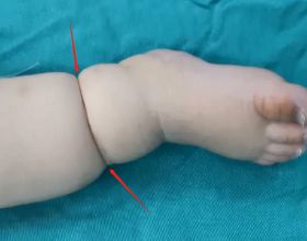 寶寶出生後小胳膊小腿肥嘟嘟的，到底是肥胖皺褶還是束帶綜合徵？