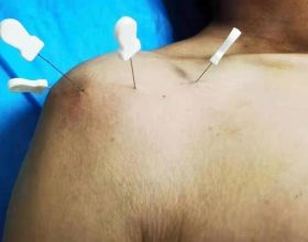 南華醫院疼痛康復科：神奇小針刀，精準“秒殺”患者疼痛