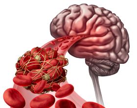 腦血管堵塞的7大徵兆，你知道嗎？