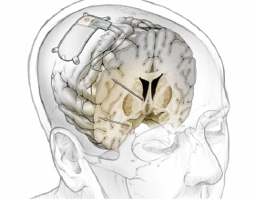 科學家開發實驗性大腦植入物 可透過電刺激某些大腦區域治療抑鬱症