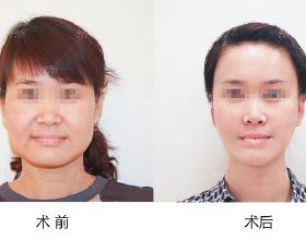 「案例分析」49歲的李女士，PSV面部提升後，脖子怎麼也變長了？