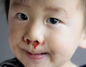 4歲男孩鼻子流血，爸爸“三個果斷”救了孩子，醫生：值得借鑑