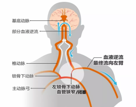 北京老年醫院成功完成經橈動脈入路慢性鎖骨下動脈閉塞再通術