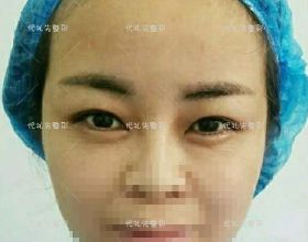 45歲姐姐做了平行雙眼皮+微創小切口提升，又重新回到了35歲