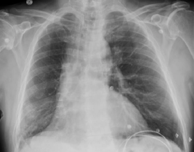 62歲男性患者呼吸急促、乾咳3個月，卻被誤診3個月，這樣的事件你能接受嗎？