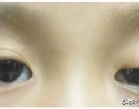 眼修復孫灃博士：上瞼下垂和腫眼泡哪一個問題更嚴重？