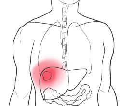 醫生提示：當肝臟開始出現纖維化，身體或有這些症狀表現，需警惕