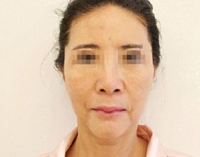 「52歲的趙女士」赴韓整形失敗，PSV面部提升3個月談談我的感受