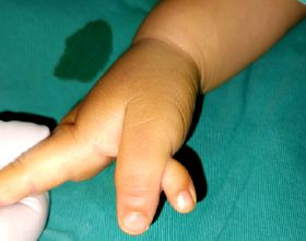 多指等手足畸形為什麼會出現？怎樣降低孩子出現手足畸形的機率？