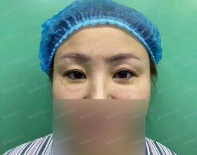 說一說我在北京做“眼周年輕化手術”的親身經歷和感受