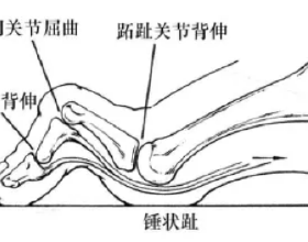 飯後頭暈甚至暈厥？警惕餐後低血壓