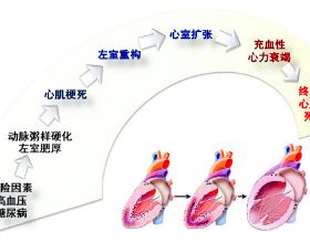 心室肥厚、心臟擴大、心力衰竭，高血壓下的心臟都經歷了什麼？