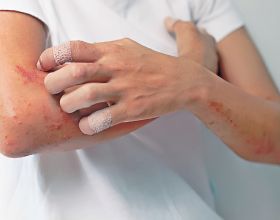 值得注意：溼疹和這3種皮膚病容易混淆！對症治療才有效