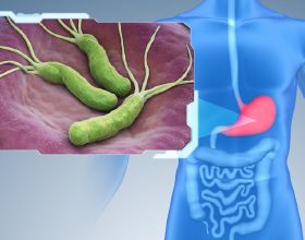 胃病最大的禍根是幽門螺桿菌，想要徹底殺菌，記住4個辦法