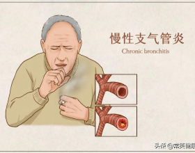 慢性支氣管炎危害大，如何正確預防呢？
