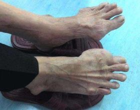 純素後出現營養不良的狀況，如何解決？