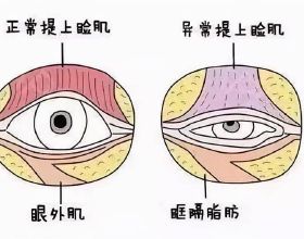 上瞼提肌是什麼？上眼瞼肌無力怎麼辦？