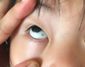 孩子眼白有“黑點”，需要治療嗎？