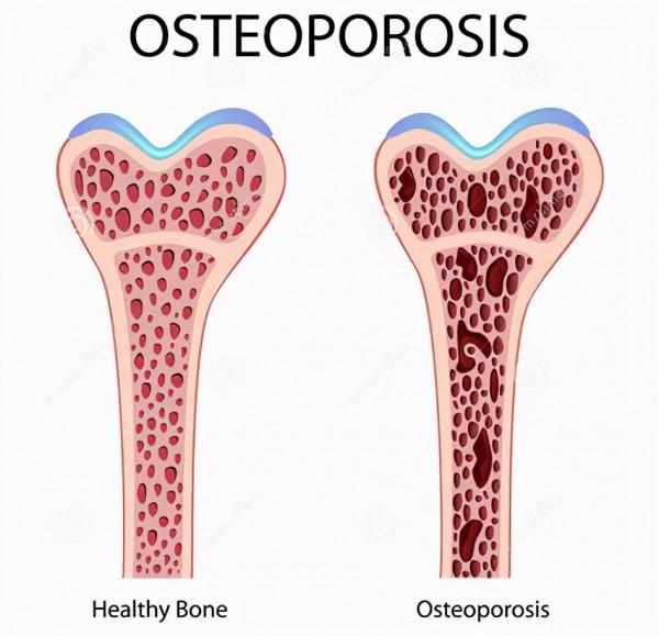 老年人膝關節退變疼痛難忍？7個用藥知識幫您遠離畸形和殘疾