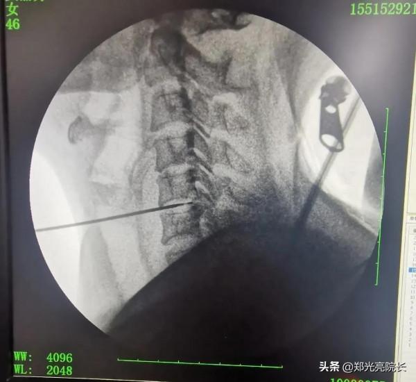 頸椎病保健“三步曲”