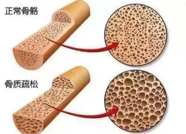 血脂恢復正常了，他汀類藥物能不能減半服用？本文為你講清楚