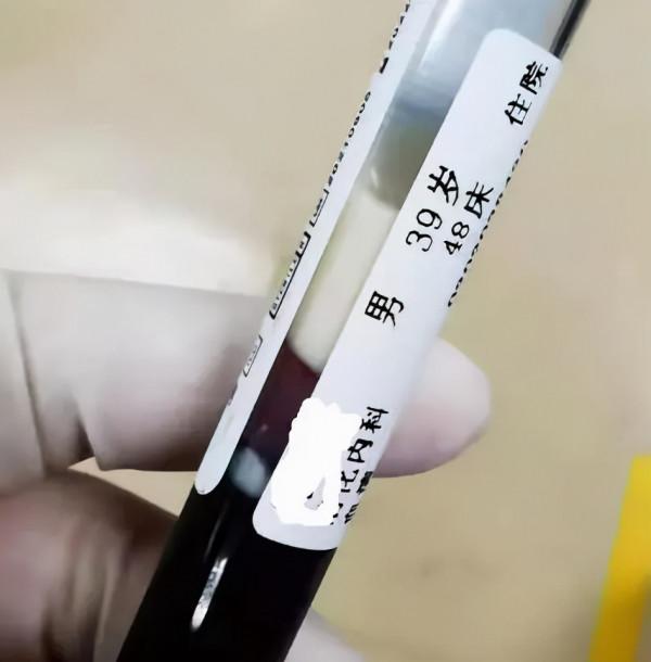 提醒愛喝酒的人：酒後出現6個症狀，十有八九是胰腺炎，儘快就醫