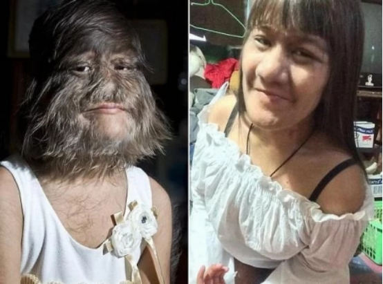 泰國女孩臉上長滿毛髮，長相特殊受盡嘲諷，父母卻視她為掌上明珠