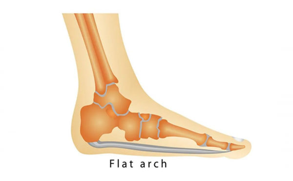 壓腳背真的能瘦成漫畫腿嗎?這一篇為你去偽存真 壓腳背真的能瘦成漫畫腿嗎?這一篇為你去偽存真