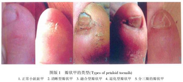 小腳趾甲長成兩瓣是啥人？據說朱元璋刀砍認親，或是純種漢人後代