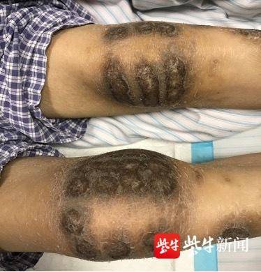 世界關節炎日丨偏方治療類風溼關節炎?當心留下難言的“痛” 世界關節炎日丨偏方治療類風溼關節炎?當心留下難言的“痛”