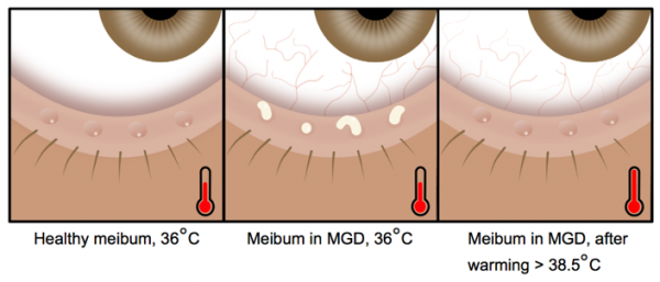 「惟視眼科」告別乾眼，眼部SPA之溫溼空氣加熱護目鏡