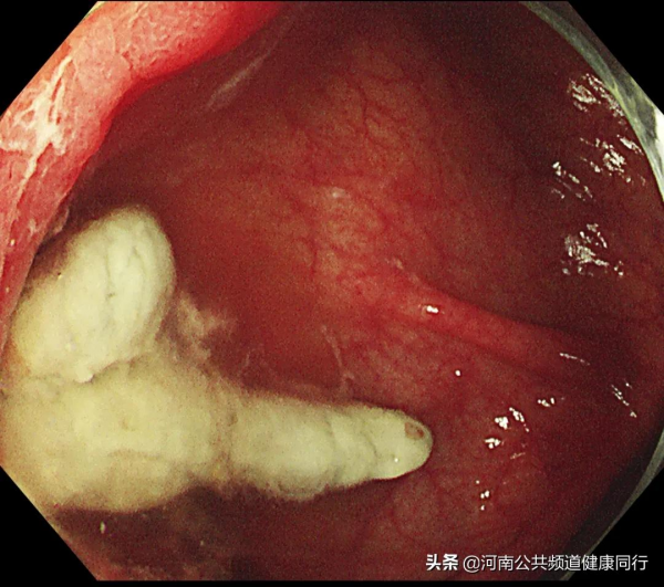 “偽裝的糞石”——在鄭大一附院進行的一例特殊的盲腸隆起型病變內鏡下治療