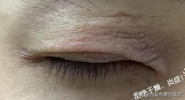 #安心變美課堂##我的安心變美推薦# 眼皮越來越松，怎麼辦？