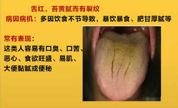 舌頭邊緣有齒痕，舌苔中間有裂紋？3種齒痕5種裂紋，你是哪一種？