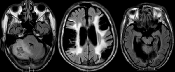 失眠、認不出家人、動手打人,他是怎麼了? 失眠、認不出家人、動手打人,他是怎麼了?