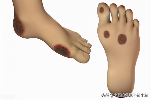 便宜的維生素B12是營養神經、改善貧血的良藥，服用時應注意5點