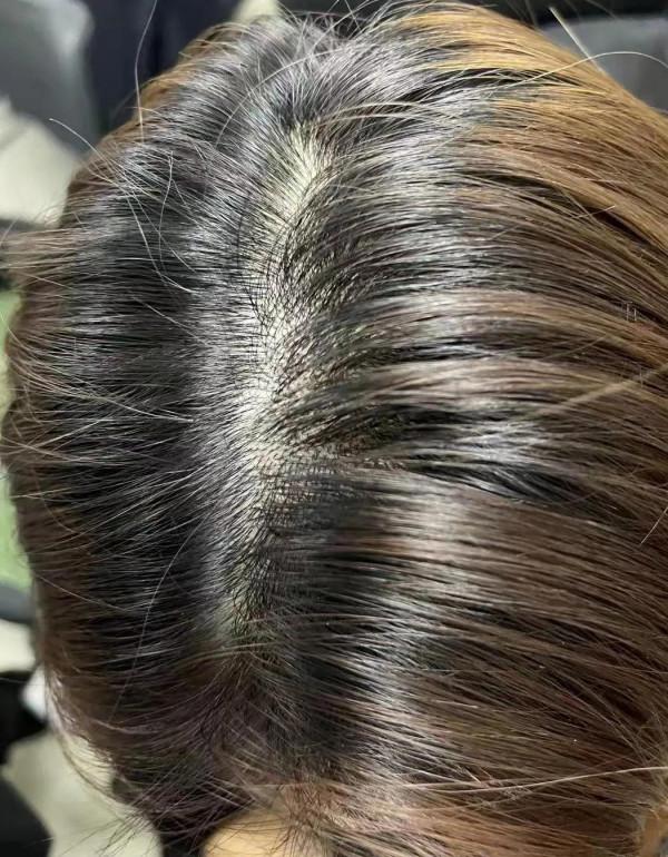 脫髮掉頭髮嚴重,先從調理腎氣開始 脫髮掉頭髮嚴重,先從調理腎氣開始