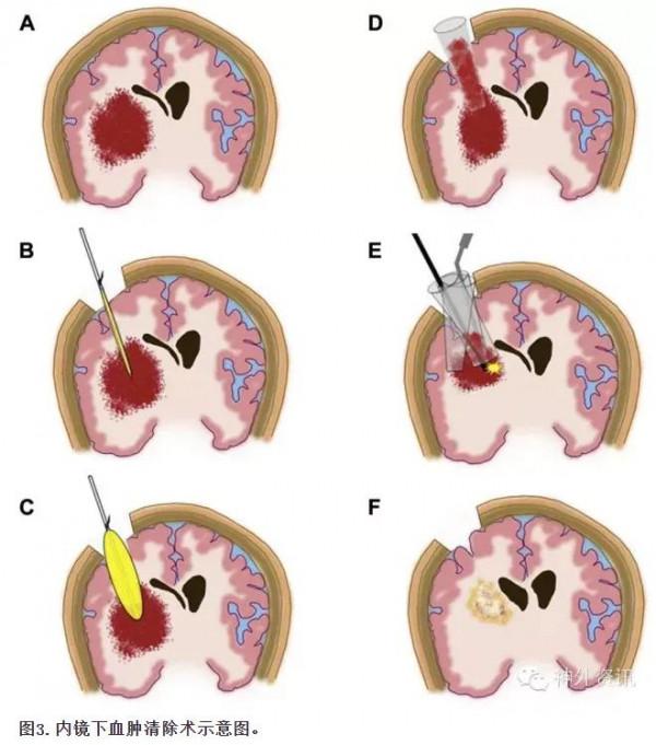 秋風蕭瑟,當心腦出血 秋風蕭瑟,當心腦出血