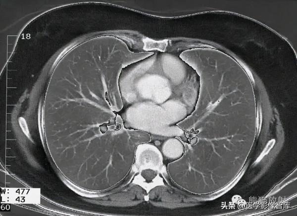 CT斷層解剖圖譜最全總結「推薦收藏」 CT斷層解剖圖譜最全總結「推薦收藏」