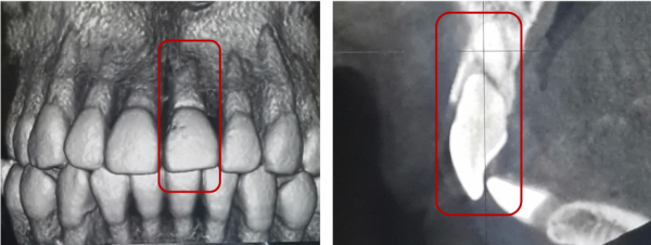 牙齒受了外傷，你知道該怎麼辦嗎？