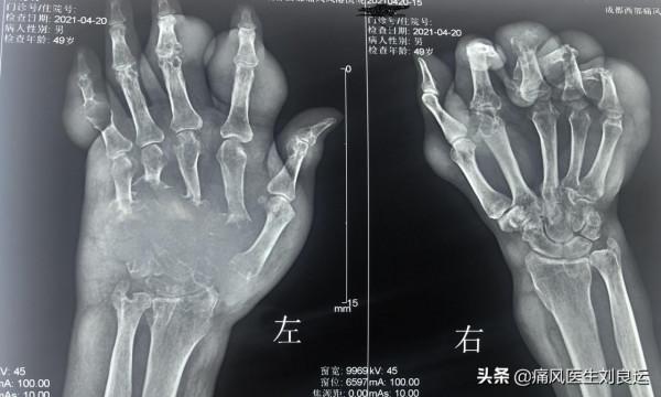 飲食清淡卻患上痛風這種“富貴病”，26歲小夥用針挑破痛風石