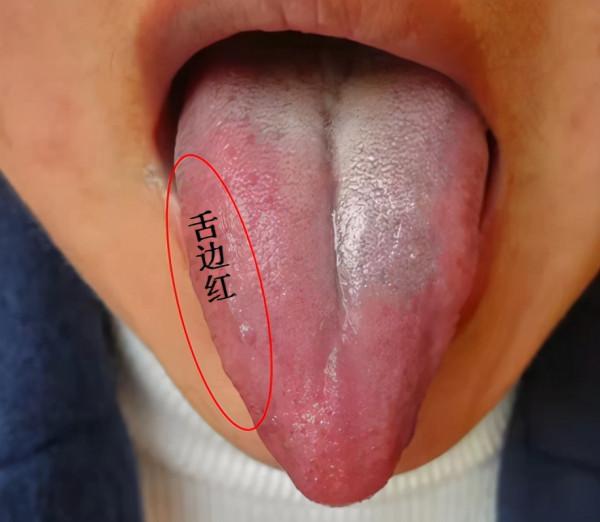 舌尖紅心火旺，舌邊紅肝火旺，舌全紅胃火旺，送你簡單應對方法