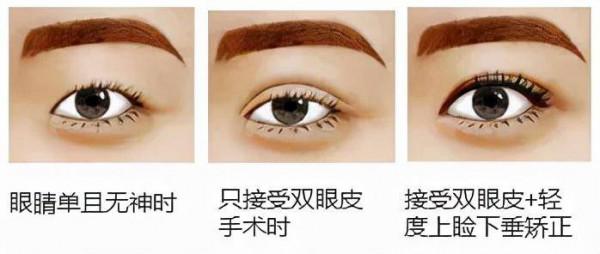 上瞼提肌是什麼？上眼瞼肌無力怎麼辦？